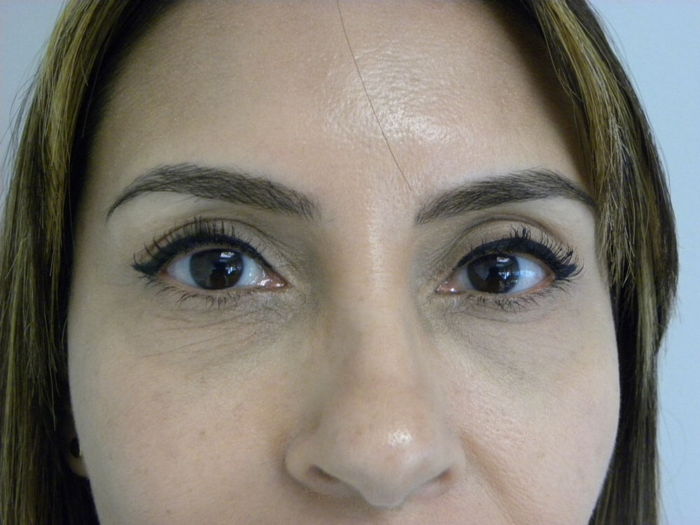Blepharoplasty before and after - after