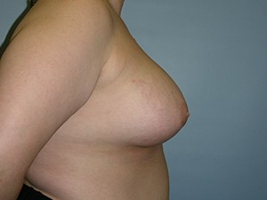 Breast Augmentation before and after - after