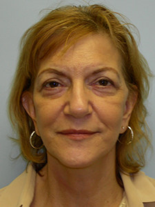 Facelift before and after - after