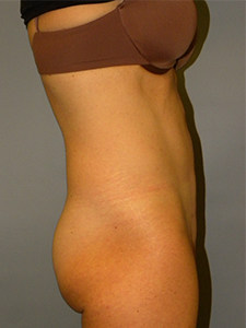 Liposuction before and after - after