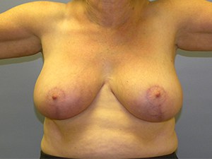 Breast Reduction before and after - after