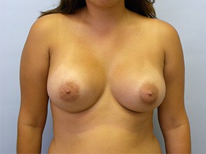 Breast Augmentation before and after - after