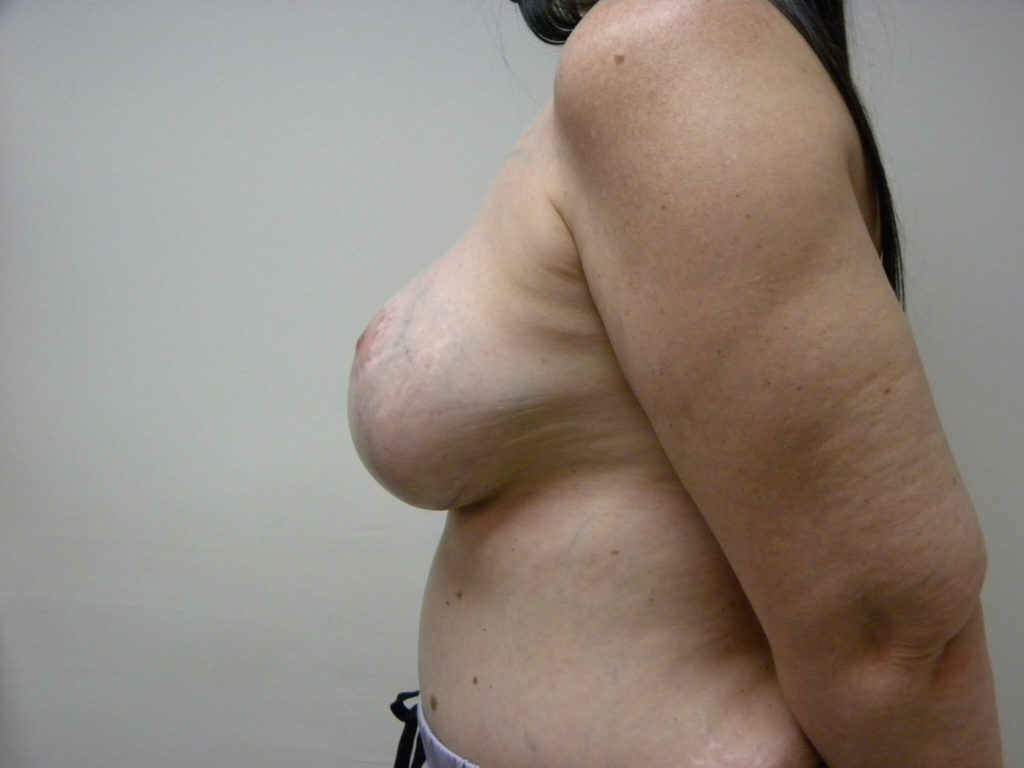 Breast Augmentation before and after - after