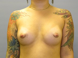 Breast Augmentation before and after - after