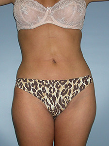 Liposuction before and after - after