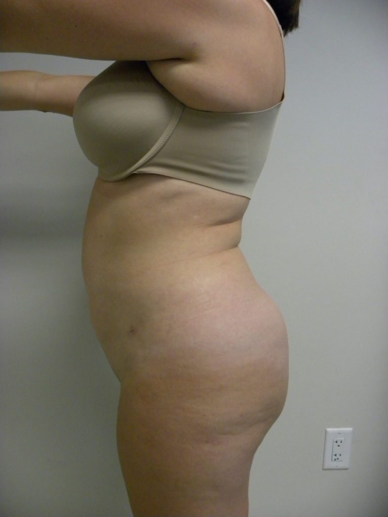 Liposuction before and after - after