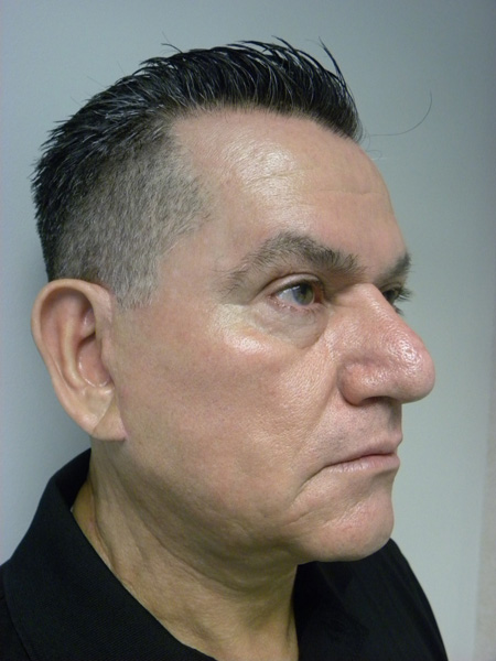 Facelift before and after - after