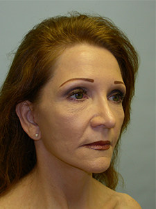 Facelift before and after - after