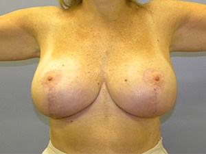 Breast Reduction before and after - after