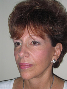 Facelift before and after - after