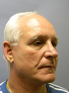 Facelift before and after - after