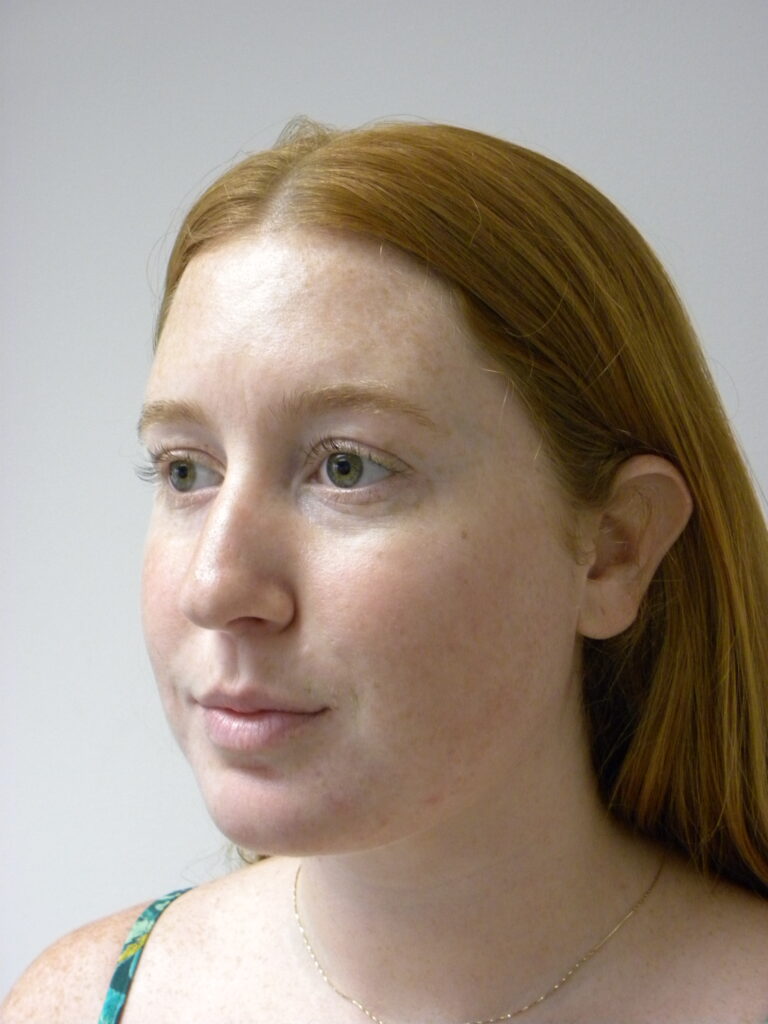 Chin before and after - after