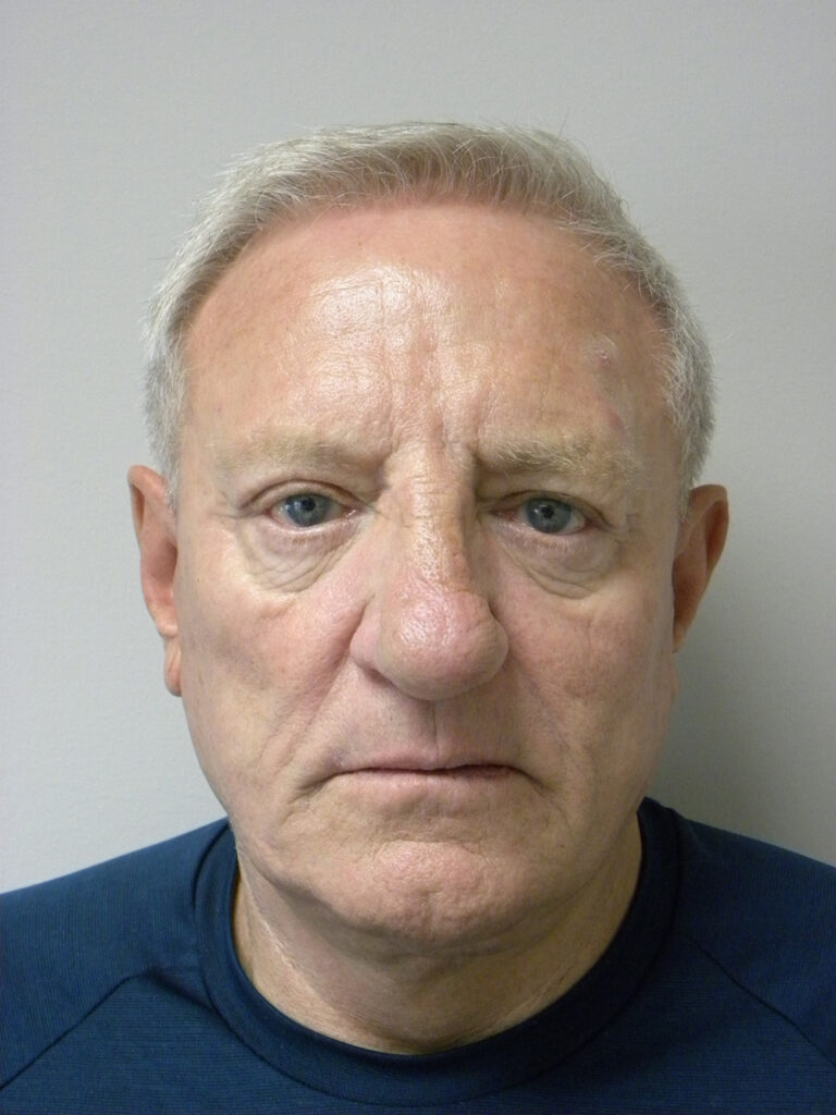 Facelift before and after - after
