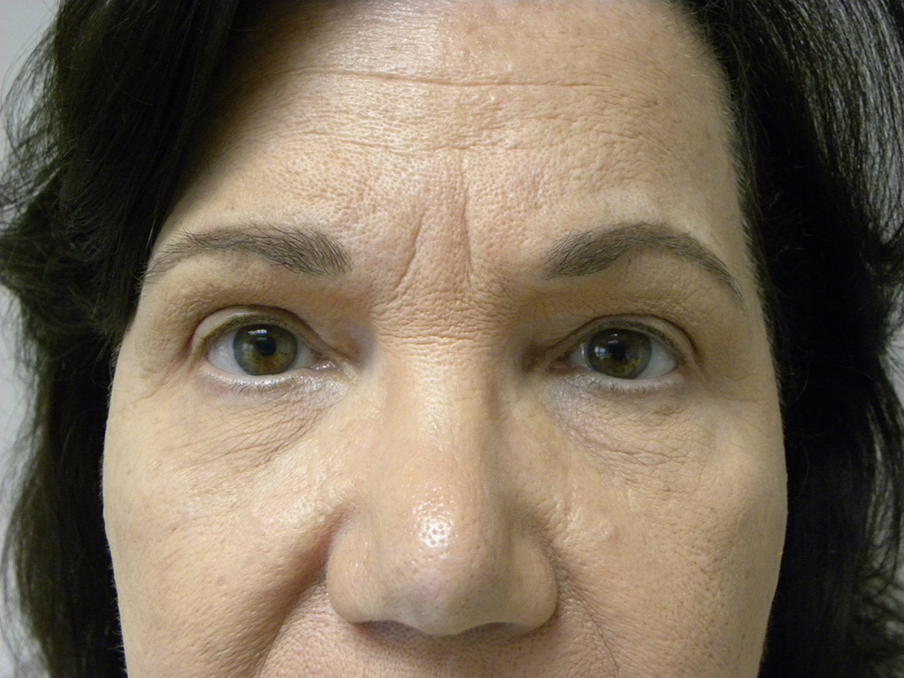 Blepharoplasty before and after - after