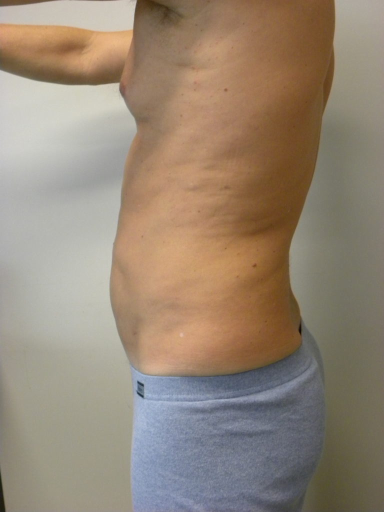 Liposuction before and after - after