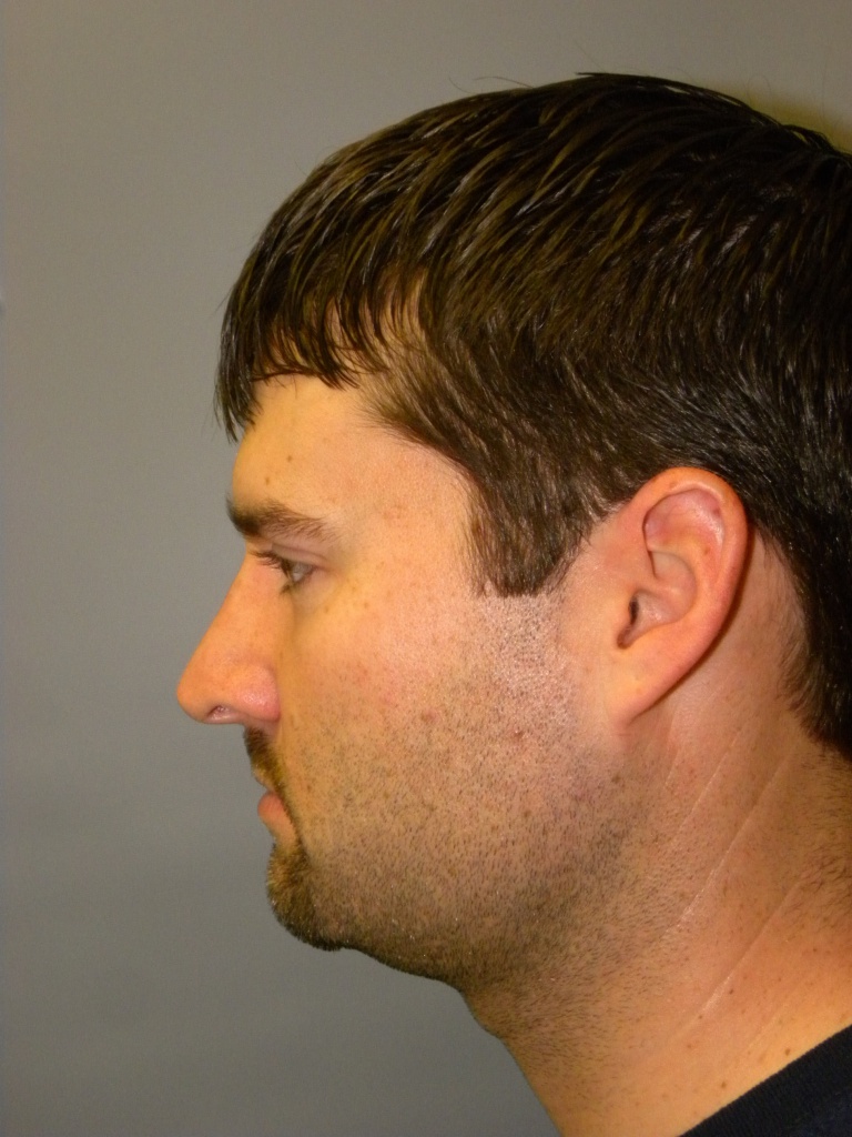 Liposuction before and after - after