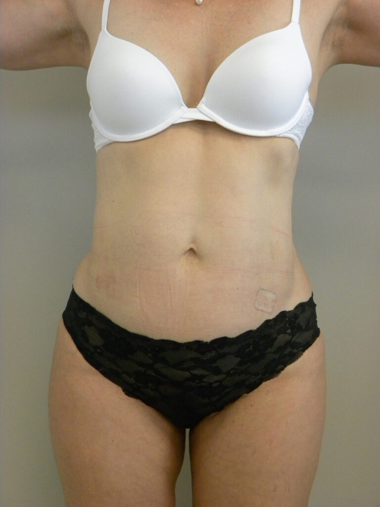 Liposuction before and after - after