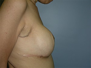 Breast Augmentation before and after - after