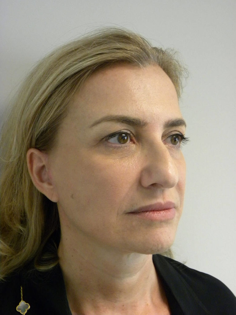 Facelift before and after - after