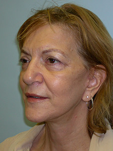 Facelift before and after - after