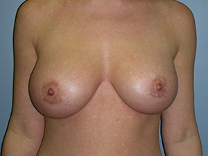 Breast Augmentation before and after - after
