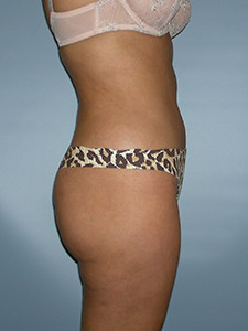 Liposuction before and after - after