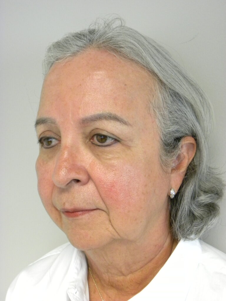 Blepharoplasty before and after - after