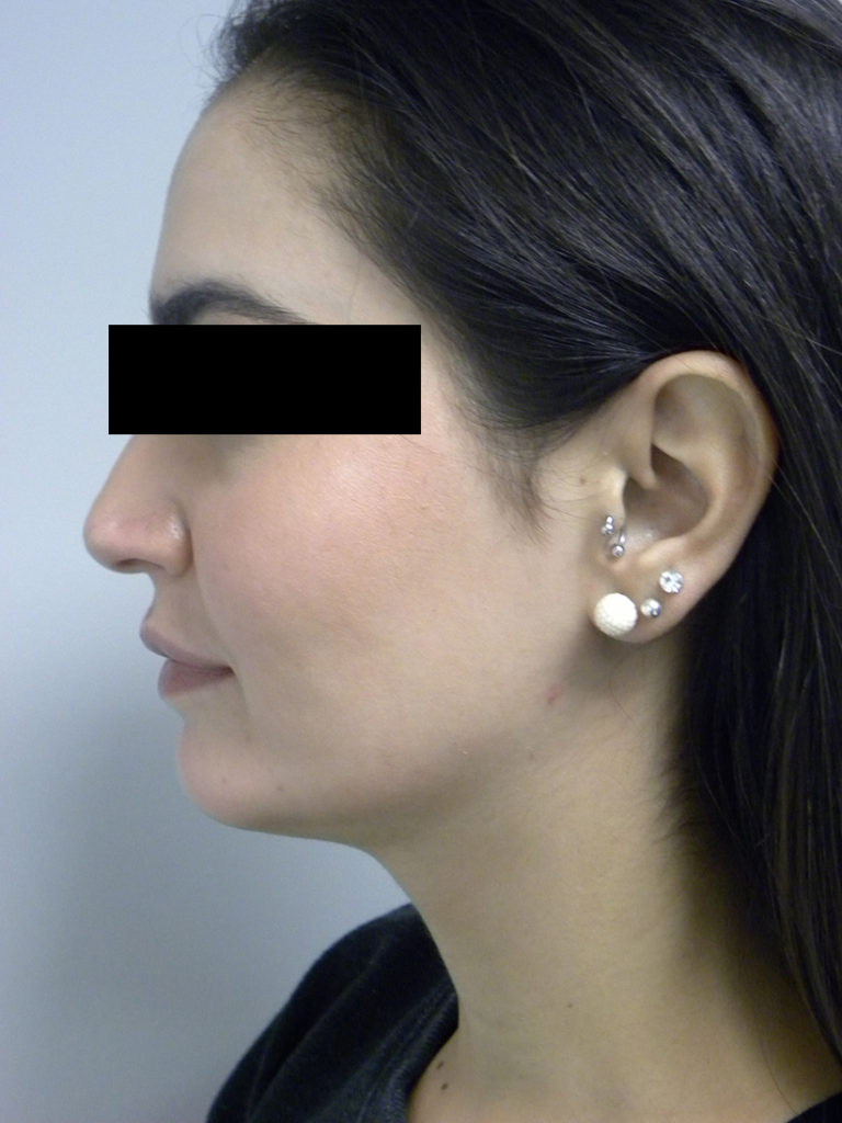 Chin before and after - after
