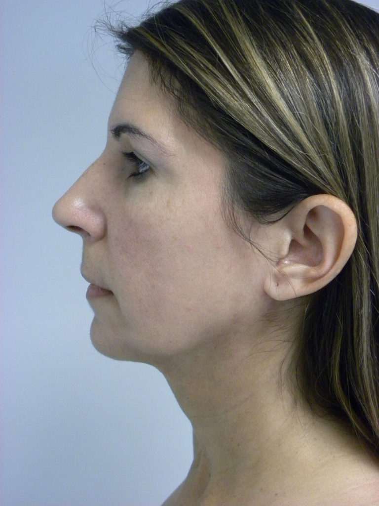Chin before and after - after