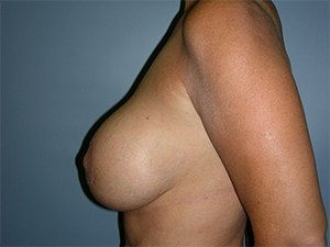 Breast Augmentation before and after - after