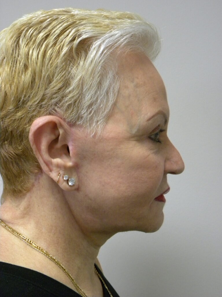 Facelift before and after - after