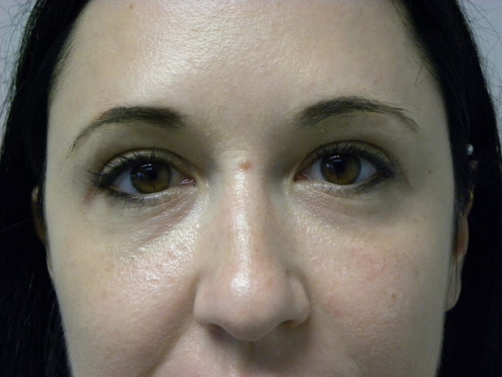 Blepharoplasty before and after - after