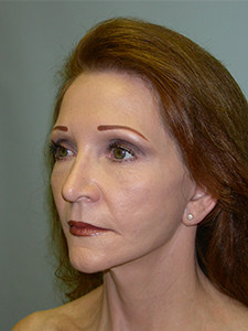Facelift before and after - after