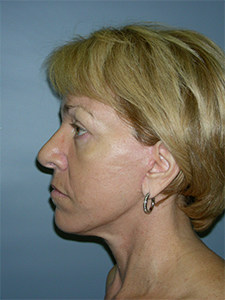Facelift before and after - after