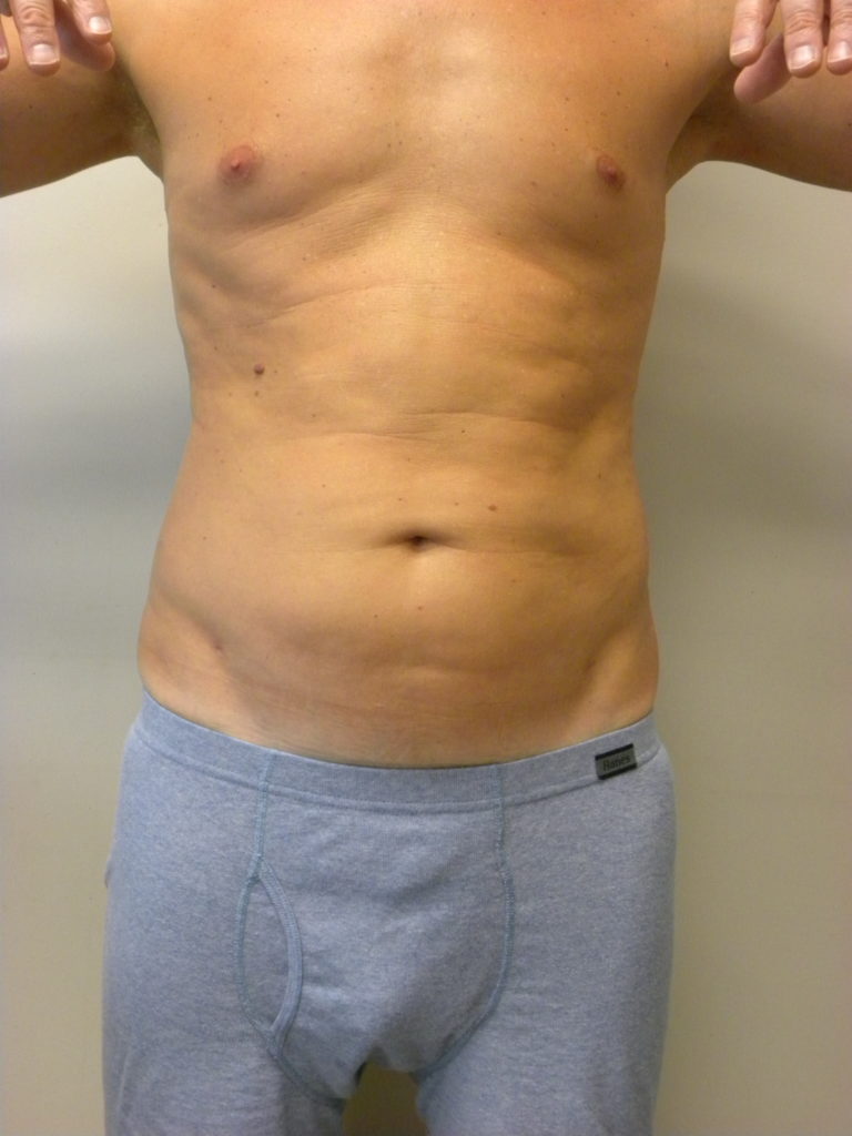 Liposuction before and after - after
