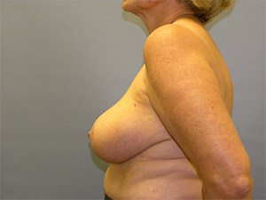 Breast Reduction before and after - after