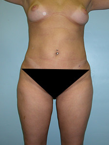 Liposuction before and after - after