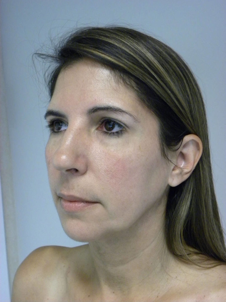 Chin before and after - after