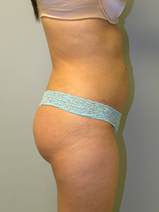 Liposuction before and after - after