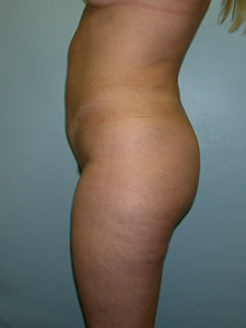 Liposuction before and after - after