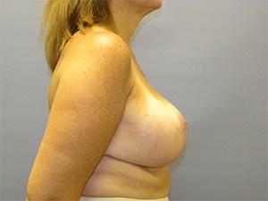 Breast Reduction before and after - after