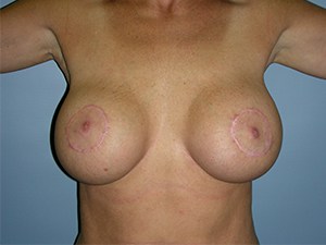 Breast Augmentation before and after - after