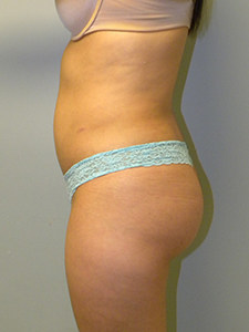 Liposuction before and after - after
