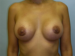 Breast Augmentation before and after - after