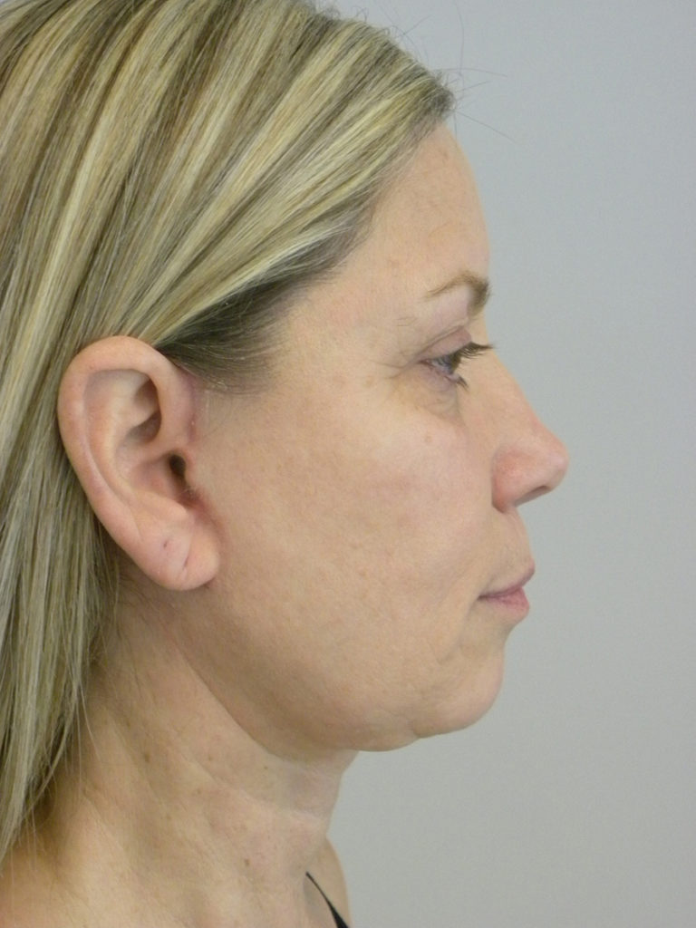 Facelift before and after - after