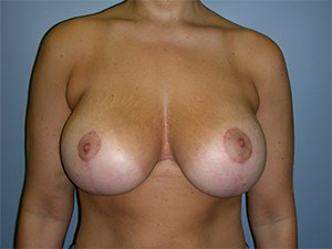 Breast Lift before and after - after