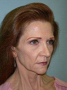 Facelift before and after - before