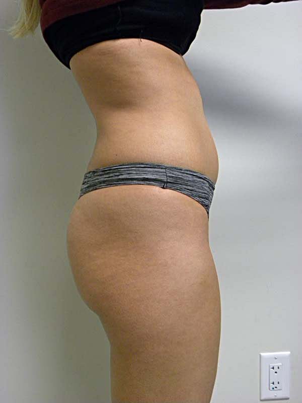 Liposuction before and after - before
