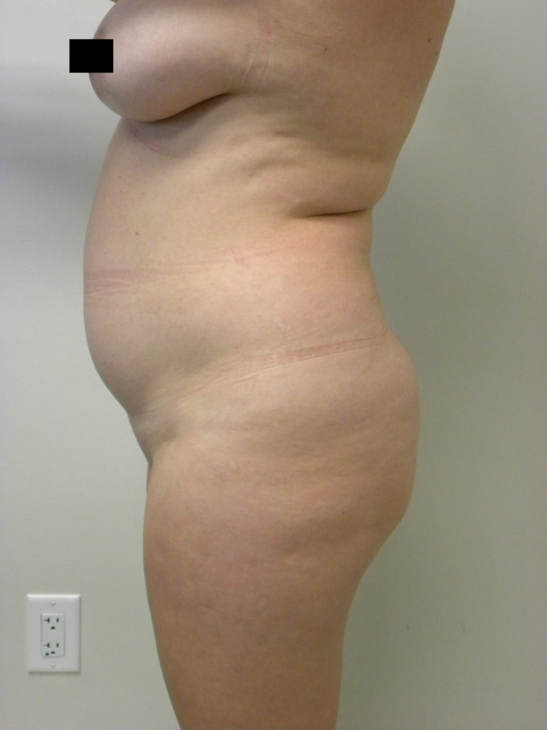 Liposuction before and after - before