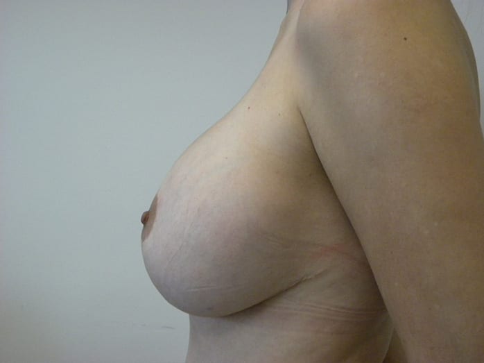 Breast Augmentation before and after - before